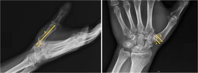 Arthroscopy-assisted partial trapeziectomy combined with ligament reconstruction for thumb carpometacarpal joint osteoarthritis: A different technique